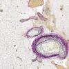 11C Infarct, 1-2 days, PMNs, DDx vasculitis (Case 11) Elastin