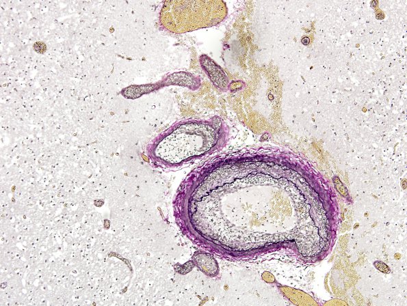 11C Infarct, 1-2 days, PMNs, DDx vasculitis (Case 11) Elastin