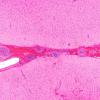 12A2 Lymphoma, Intravascular with angiitis (Case 12) H&E 4X