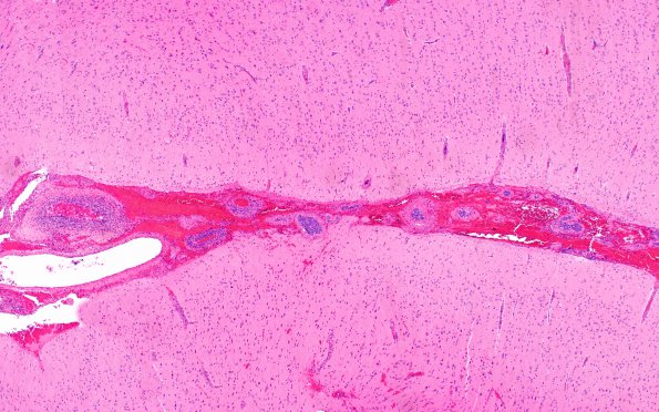 12A2 Lymphoma, Intravascular with angiitis (Case 12) H&E 4X