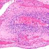 12A3 Lymphoma, Intravascular with angiitis (Case 12) H&E 20X