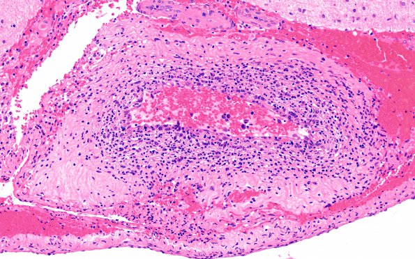 12A3 Lymphoma, Intravascular with angiitis (Case 12) H&E 20X