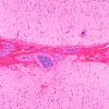 12A4 Lymphoma, Intravascular with angiitis (Case 12) H&E 10X