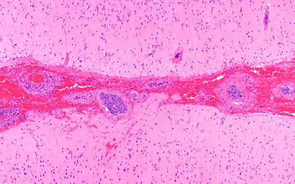 12A4 Lymphoma, Intravascular with angiitis (Case 12) H&E 10X