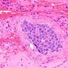 12A5 Lymphoma, Intravascular with angiitis (Case 12) H&E 40X