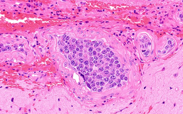 12A5 Lymphoma, Intravascular with angiitis (Case 12) H&E 40X