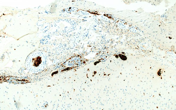 12B1 Lymphoma, Intravascular with angiitis (Case 12) CD20 A1 10X 1