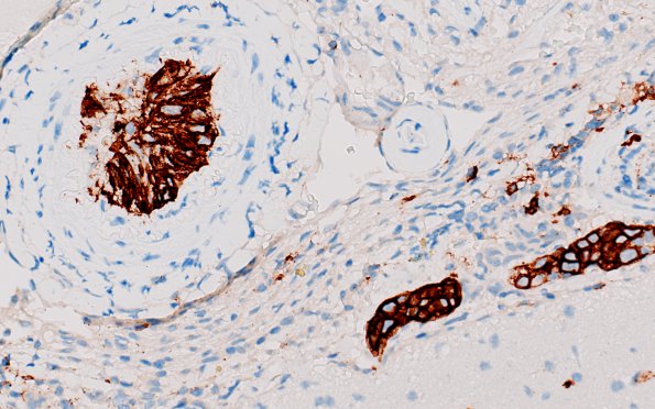 12B2 Lymphoma, Intravascular with angiitis (Case 12) CD20 A1 40X 1