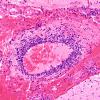 12C1 Lymphoma, Intravascular with angiitis (Case 12) H&E 20X 2