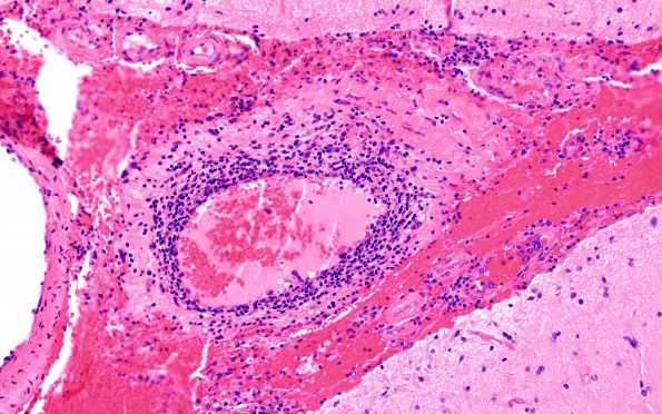 12C1 Lymphoma, Intravascular with angiitis (Case 12) H&E 20X 2