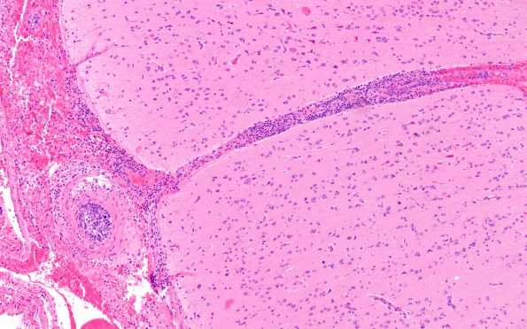 12C2 Lymphoma, Intravascular with angiitis (Case 12) H&E A1 10X 2