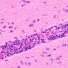 12C4 Lymphoma, Intravascular with angiitis (Case 12) H&E A1 40X 2