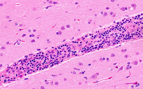 12C4 Lymphoma, Intravascular with angiitis (Case 12) H&E A1 40X 2