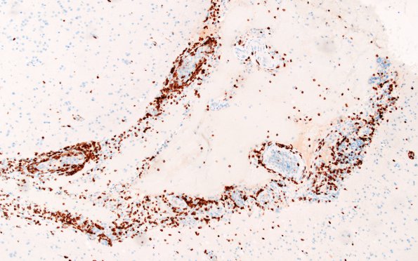 12D1 Lymphoma, Intravascular with angiitis (Case 12) CD3 A1 10X 1