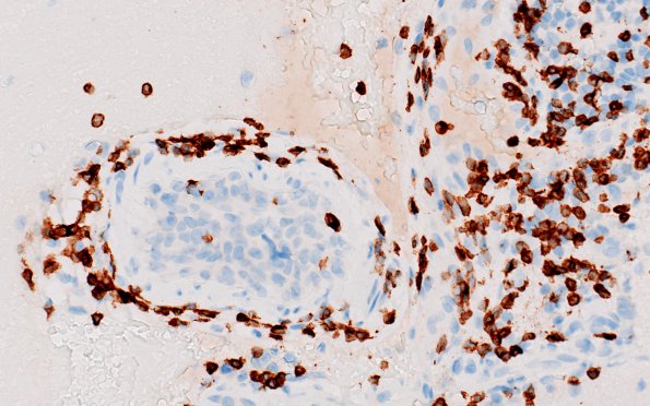 12D2 Lymphoma, Intravascular with angiitis (Case 12) CD3 A1 40X 1