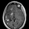 13A1 Vasculitis (Case 13) 1-23-2015 MPRAGE T1 With contrast 2 - Copy