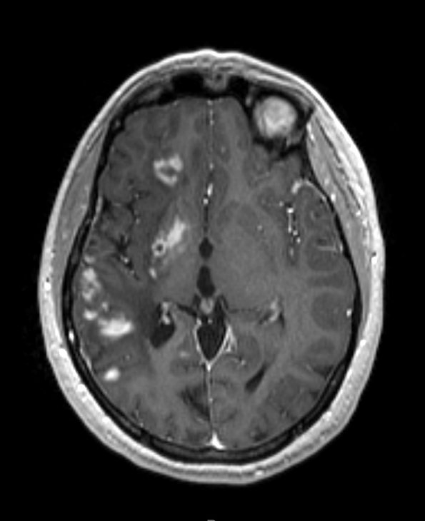 13A1 Vasculitis (Case 13) 1-23-2015 MPRAGE T1 With contrast 2 - Copy