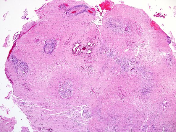 13B1 Vasculitis, Unilateral, Rasmussen Mimic (Case 13) H&E 5