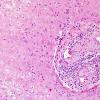 13B2 Vasculitis, Unilateral, Rasmussen Mimic (Case 13) H&E 4