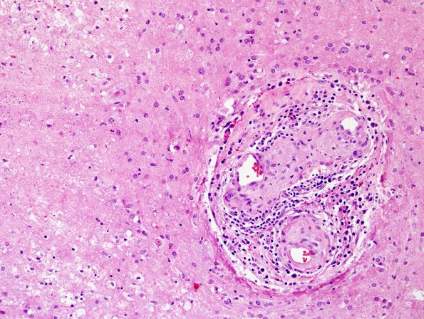 13B2 Vasculitis, Unilateral, Rasmussen Mimic (Case 13) H&E 4