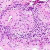 13B3 Vasculitis, Unilateral, Rasmussen Mimic (Case 13) H&E 8