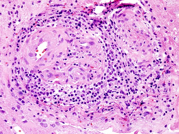 13B3 Vasculitis, Unilateral, Rasmussen Mimic (Case 13) H&E 8