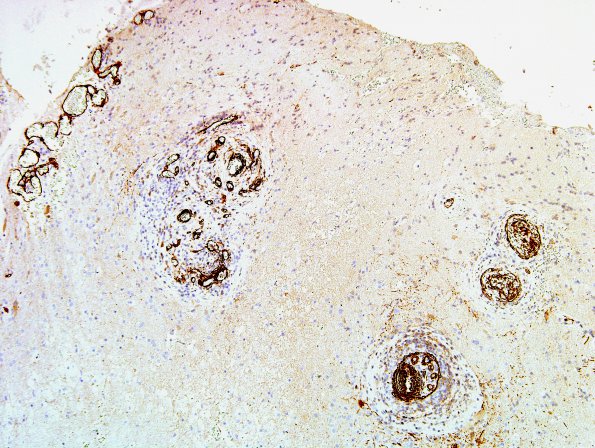 13C1 Vasculitis, Unilateral, Rasmussen Mimic (Case 13) SMA 5