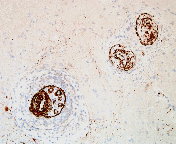 13C2 Vasculitis, Unilateral, Rasmussen Mimic (Case 13) SMA 6