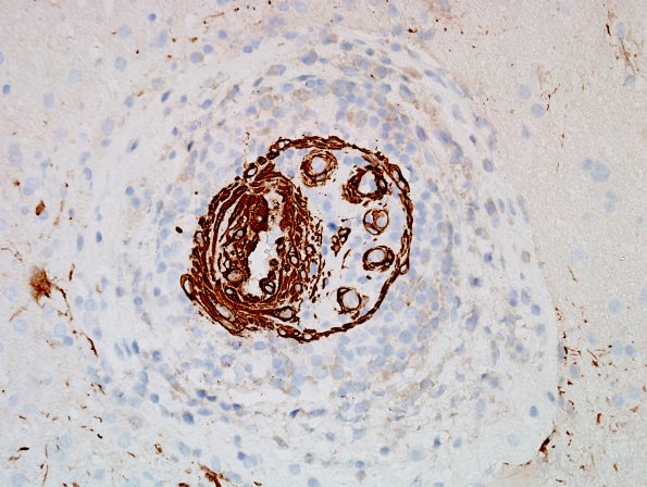 13C3 Vasculitis (Case 13) SMA