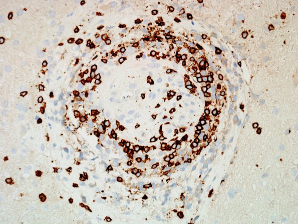 13D Vasculitis, Unilateral, Rasmussen Mimic (Case 13) CD3 2