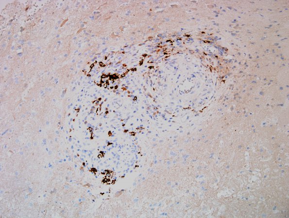 13E Vasculitis, Unilateral, Rasmussen Mimic (Case 13) CD20 1.