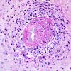 13F2 Vasculitis, Unilateral, Rasmussen Mimic (Case 13) PAS 2