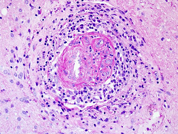 13F2 Vasculitis, Unilateral, Rasmussen Mimic (Case 13) PAS 2