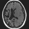 13G1 Vasculitis (Case 13) 2-14-2019 T2 FLAIR 2 - Copy