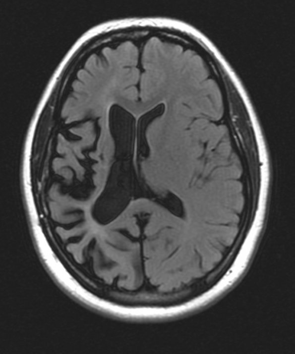 13G1 Vasculitis (Case 13) 2-14-2019 T2 FLAIR 2 - Copy