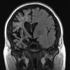 13G2 Vasculitis (Case 13) 2-14-2019 T2 FLAIR - Copy