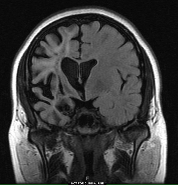 13G2 Vasculitis (Case 13) 2-14-2019 T2 FLAIR - Copy