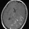 14A1 Vasculitis, granulomatous (Case 14) T1 W 2 - Copy