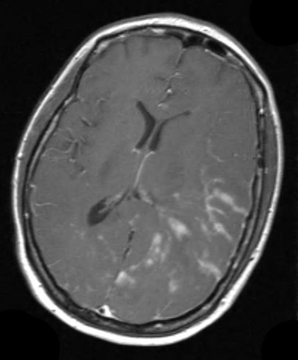 14A1 Vasculitis, granulomatous (Case 14) T1 W 2 - Copy