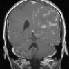 14A2 Vasculitis, granulomatous (Case 14) T1 W 3 - Copy