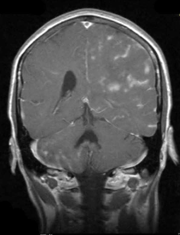 14A2 Vasculitis, granulomatous (Case 14) T1 W 3 - Copy