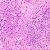 14B2 Vasculitis, granulomatous (Case 14) H&E 1