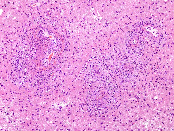 14B2 Vasculitis, granulomatous (Case 14) H&E 1