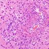 14B3 Vasculitis, granulomatous (Case 14) H&E 2