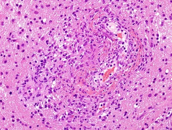 14B3 Vasculitis, granulomatous (Case 14) H&E 2