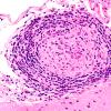 14B4 Vasculitis, granulomatous (Case 14) A1 40X H&E