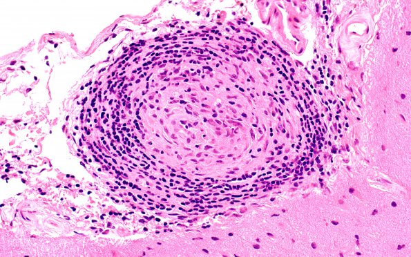 14B4 Vasculitis, granulomatous (Case 14) A1 40X H&E