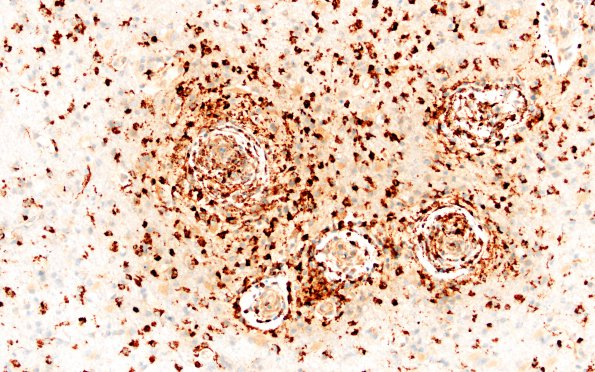 14C1 Vasculitis, granulomatous (Case 14) B1 CD68 area A 20X