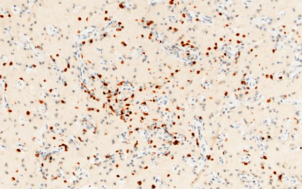 14C2 Vasculitis, granulomatous (Case 14) B1 CD3 area A 20X