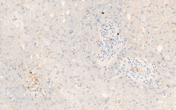 14C3 Vasculitis, granulomatous (Case 14) B1 CD20 area A 20X